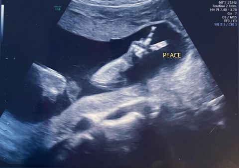 Zulay Henao's Ultrasound Picture. 